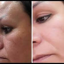 عکس قبل و بعد استفاده از کرم معجزه