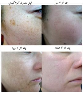 عوارض کرم گوری