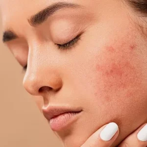 حساسیت به کرم ضد لک